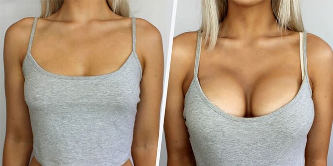 prima e dopo la chirurgia plastica per l'aumento del seno