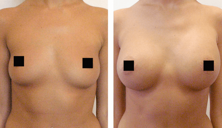 seno prima e dopo l'aumento con acido ialuronico