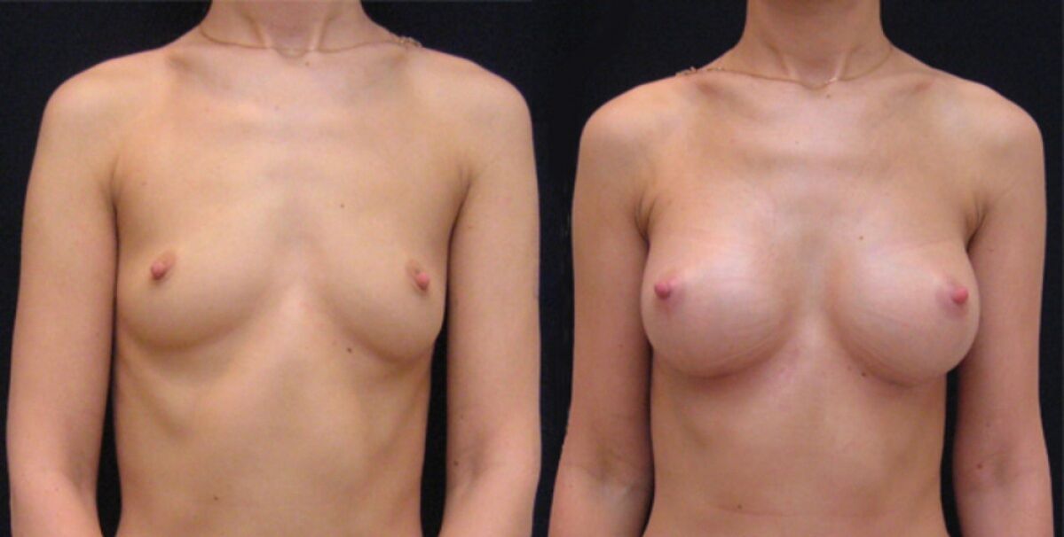 seno prima e dopo l'aumento endoscopico
