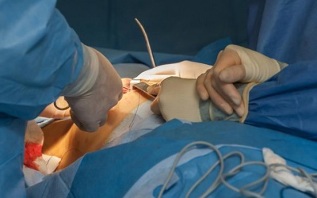 come viene eseguita la chirurgia di aumento del seno