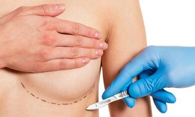 Accesso sottomammarico all'ingrandimento del seno con gli impianti