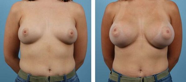 foto prima e dopo l'aumento del seno