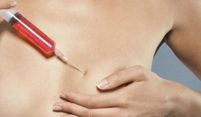 Aumento del seno con iniezioni di acido ialuronico