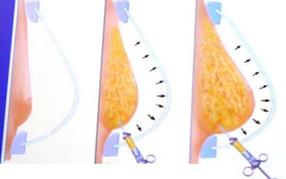 ingrandimento del seno con grasso